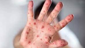 Mangaung declared measles-free as Lejweleputswa cases persist Mangaung declared measles-free as Lejweleputswa cases persist | News Article
