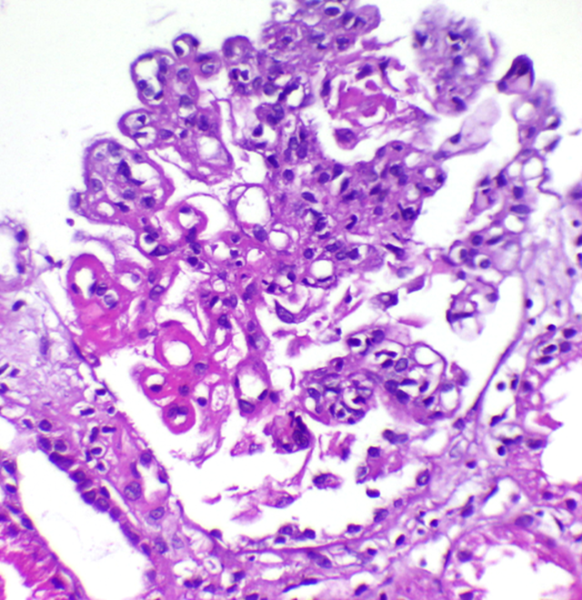 What is Lupus? | News Article
