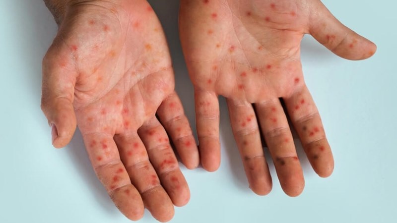 Close to 70 cases of measles reported in Free State district | News Article