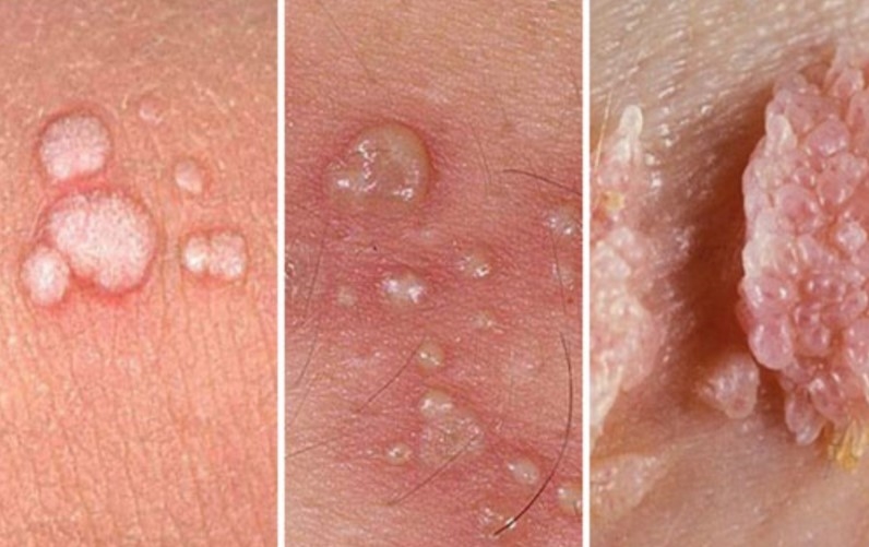 Wat jy van menslike papilloomvirus moet weet | News Article