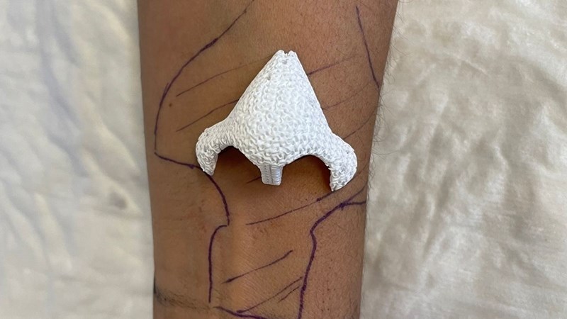 Woman grows new nose on her arm Woman grows new nose on her arm | News Article