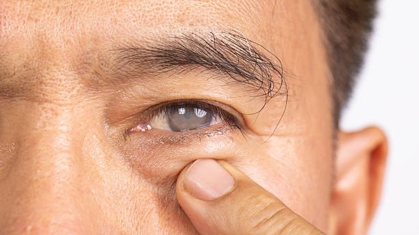 More than 1,000 free cataract surgeries planned  | News Article