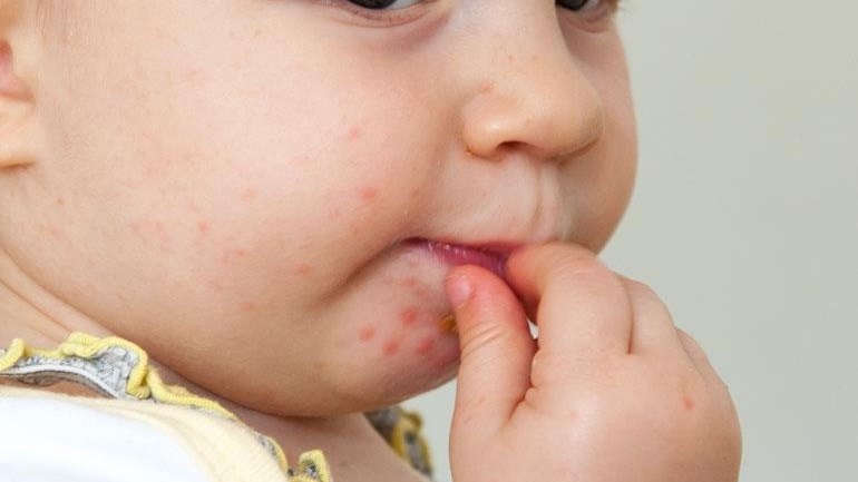 Hand-voet-en-mondsiekte kom weer voor in Sentraal-Suid-Afrika Hand-voet-en-mondsiekte kom weer voor in Sentraal-Suid-Afrika | News Article