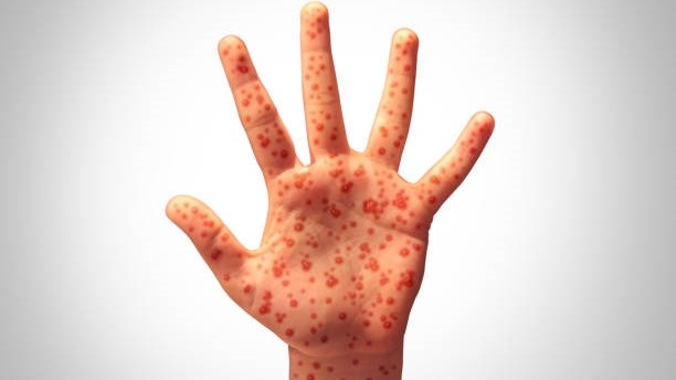 Free State parents urged to vaccinate children amid measles outbreak Free State parents urged to vaccinate children amid measles outbreak | News Article