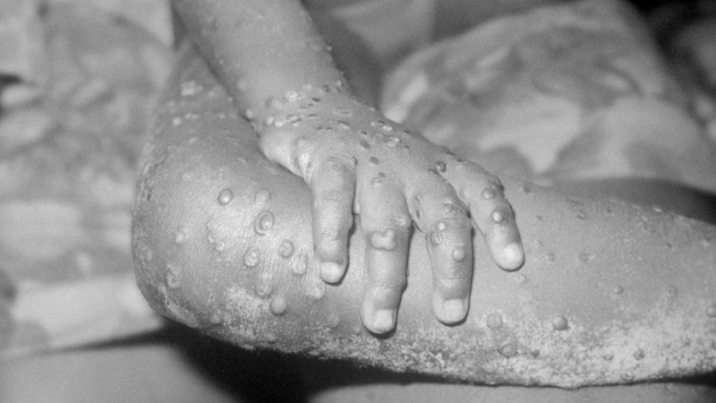 First case of Monkeypox detected in South Africa First case of Monkeypox detected in South Africa | News Article