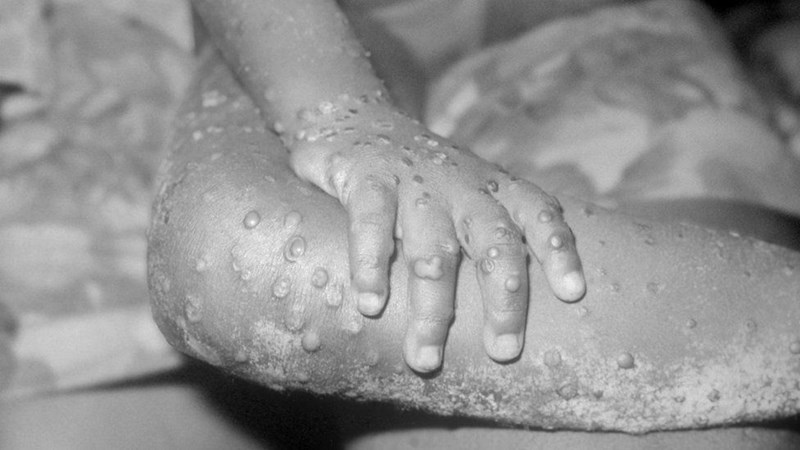 First case of Monkeypox detected in South Africa | News Article