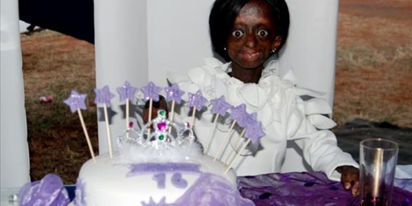 Progeria teen, Ontlametse Phalatse, dies Progeria teen, Ontlametse Phalatse, dies | News Article