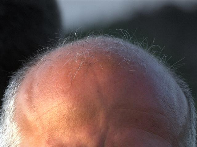 People who work longer hours 'far more likely' to go bald | News Article