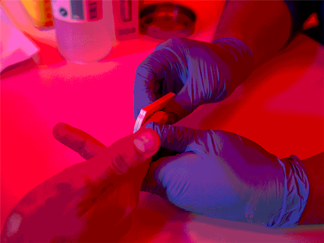 'London patient' second case ever of HIV remission | News Article
