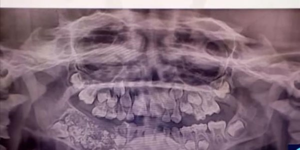 Boy has 526 teeth pulled | News Article