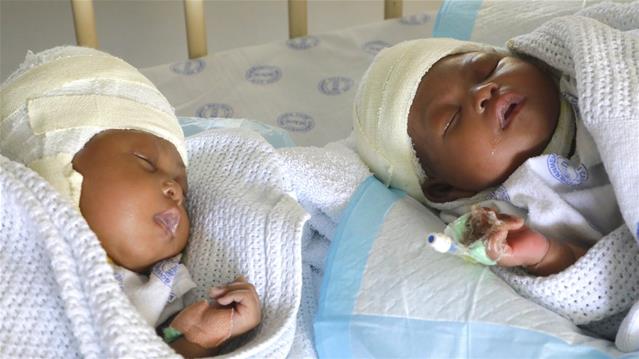 Twins joined at the head, separated | News Article